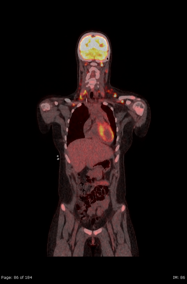 Brown fat uptake (FDG PET-CT) (Radiopaedia 77392-89513 Fused coronal 44).jpg