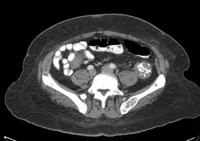 Brown tumors compressing the spinal cord (Radiopaedia 68442-77988 E 85).jpg