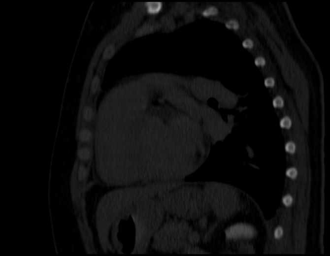 Brown tumors compressing the spinal cord (Radiopaedia 68442-77988 Sagittal bone window 37).jpg