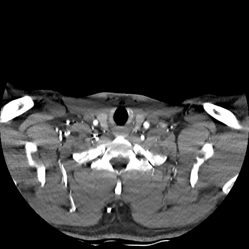 Buccal fat pad arteriovenous malformation (Radiopaedia 70936-81144 D 64).jpg