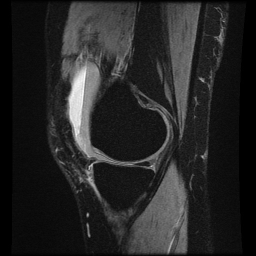 File:Bucket handle meniscus tear (Radiopaedia 56916-63751 H 61).jpg
