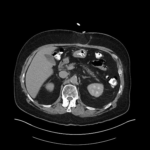 File:Buried bumper syndrome - gastrostomy tube (Radiopaedia 63843-72575 Axial Inject 2).jpg
