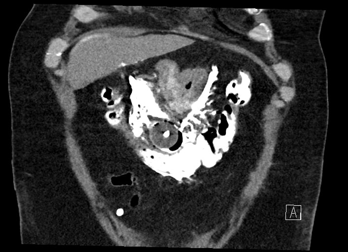 File:Buried bumper syndrome - gastrostomy tube (Radiopaedia 63843-72577 Coronal Inject 30).jpg