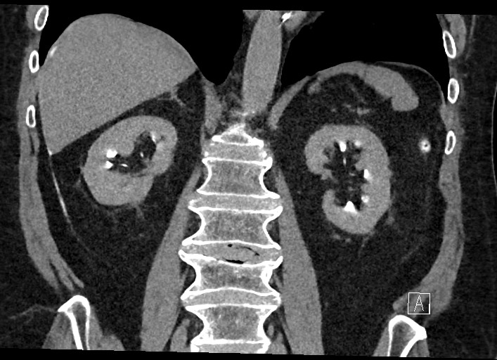 File:Buried bumper syndrome - gastrostomy tube (Radiopaedia 63843-72577 Coronal Inject 87).jpg