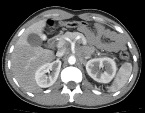File:Burned-out testicular choriocarcinoma (Radiopaedia 32822-34040 B 4).PNG