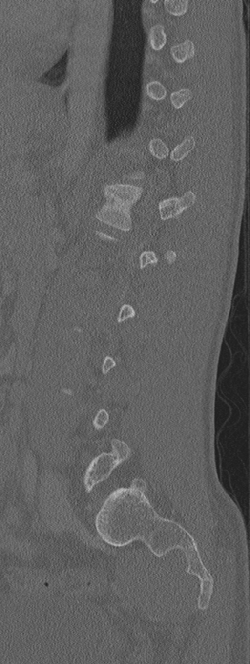 Burst fracture - T12 with conus compression (Radiopaedia 56825-63647 Sagittal bone window 26).png