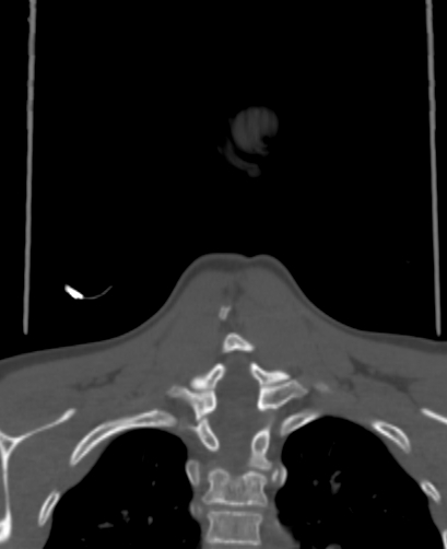 Butterfly vertebra (Radiopaedia 77903-90209 Coronal bone window 77).jpg