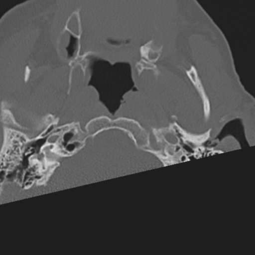 File:C2 fracture with vertebral artery dissection (Radiopaedia 37378-39199 Axial bone window 3).png