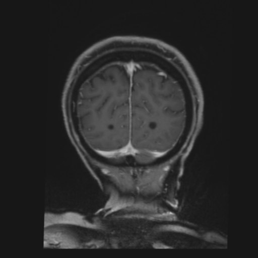 CNS lymphoma with steroid response (Radiopaedia 37980-39921 Coronal T1 C+ 44).png