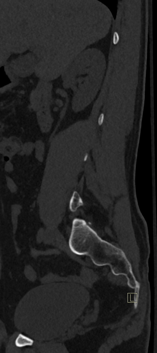 Calcaneal fractures with associated L2 burst fracture (Radiopaedia 71671-82493 Sagittal bone window 68).jpg