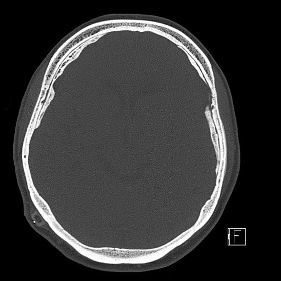 Calcified chronic subdural hematoma (Radiopaedia 77374-89492 Axial bone window 59).jpg