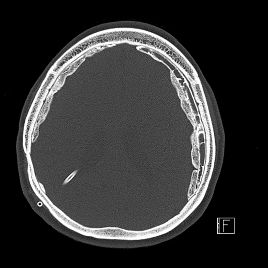 Calcified chronic subdural hematoma (Radiopaedia 77374-89492 Axial bone window 91).jpg