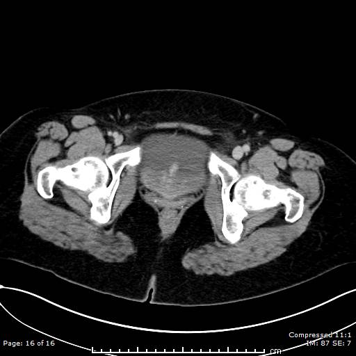 File:Calcified uterine fibroid (Radiopaedia 56077-62759 Axial 14).jpg