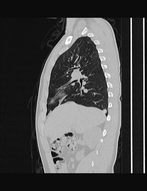 Calcifying pulmonary metastases (Radiopaedia 33359-34396 Sagittal lung window 46).jpg