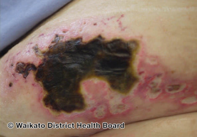 File:Calciphylaxis can lead to- (DermNet NZ systemic-w-calciphylaxis7).jpg