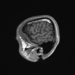 Callosal dysgenesis with interhemispheric cyst (Radiopaedia 53355-59335 Sagittal T1 156).jpg