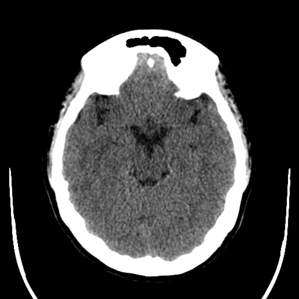 Calvarial osteoma (Radiopaedia 36520-38079 Axial non-contrast 21).jpg