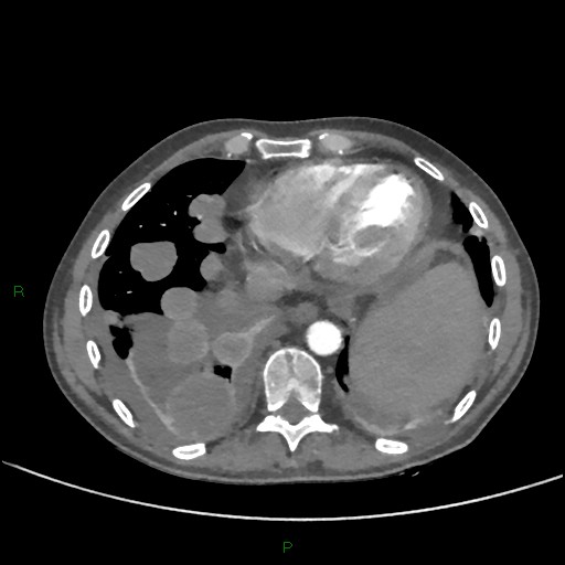 Cannonball metastases (Radiopaedia 82110-96150 Axial C+ CTPA 244).jpg