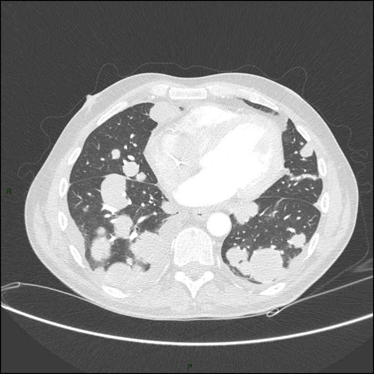 Cannonball metastases (Radiopaedia 82110-96150 Axial lung window 130).jpg
