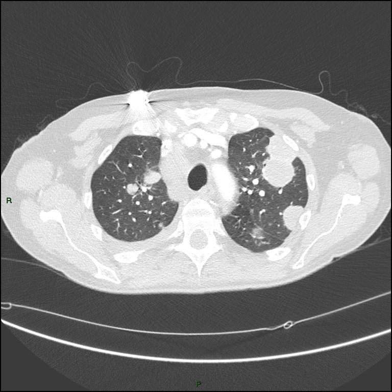 Cannonball metastases (Radiopaedia 82110-96150 Axial lung window 55).jpg