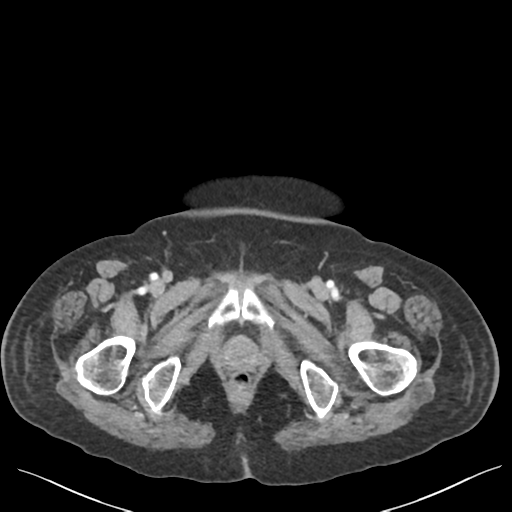 Cannonball metastases from endometrial cancer (Radiopaedia 42003-45031 E 78).png