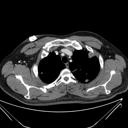 File:Cannonball pulmonary metastases (Radiopaedia 67684-77101 D 52).jpg