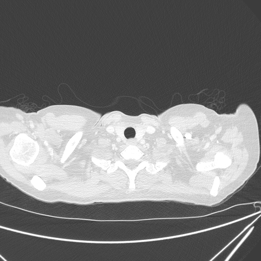 Canonball lung metastasis (Radiopaedia 77634-89837 Axial lung window 7).jpg