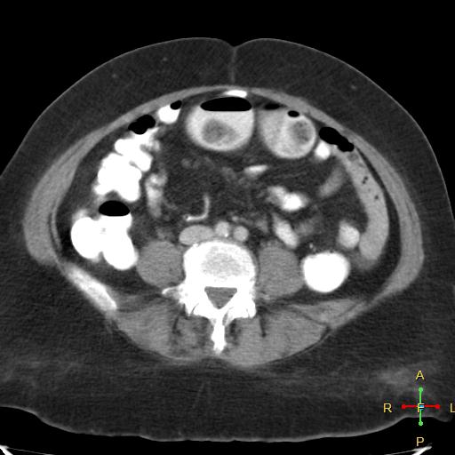 File:Carcinoma of sigmoid colon (Radiopaedia 23071-23100 B 13).jpg