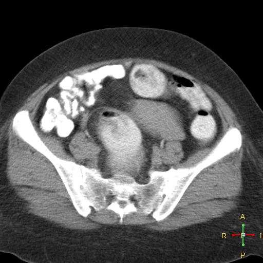 File:Carcinoma of sigmoid colon (Radiopaedia 23071-23100 C+ delayed 20).jpg