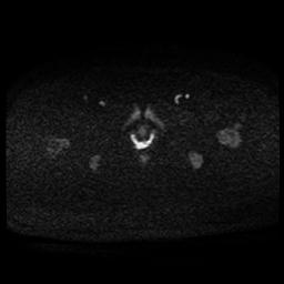 Carcinoma of the cervix (Radiopaedia 89018-105858 Axial DWI 47).jpg
