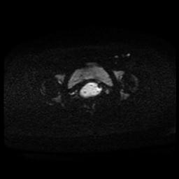 Carcinoma of the cervix (Radiopaedia 89018-105858 Axial DWI 51).jpg
