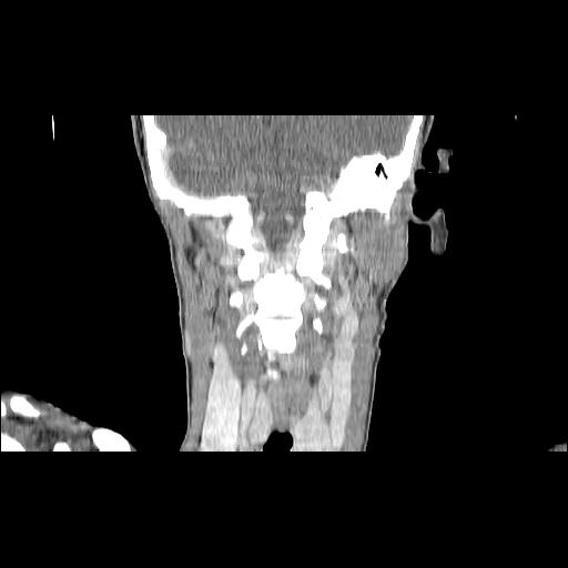 Carcinoma of the maxillary antrum (Radiopaedia 53805-59888 Coronal C+ delayed 111).jpg