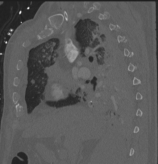Cardiac trauma (Radiopaedia 32874-33858 Sagittal bone window 68).jpg
