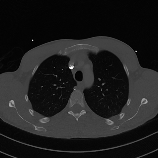 Cardiac tumor - undifferentiated pleomorphic sarcoma (Radiopaedia 45844-50134 Axial bone window 19).png