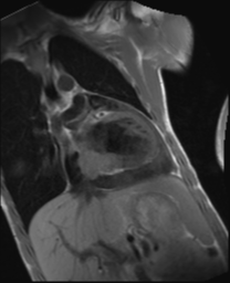 File:Cardiac tumor - undifferentiated pleomorphic sarcoma (Radiopaedia 45844-50136 Oblique T1 1).png