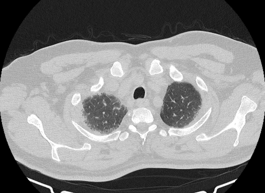 Cardiogenic pulmonary edema (Radiopaedia 68180-77678 Axial lung window 8).jpg