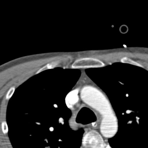File:Carotid arterial dissection (Radiopaedia 30001-30548 B 3).jpg