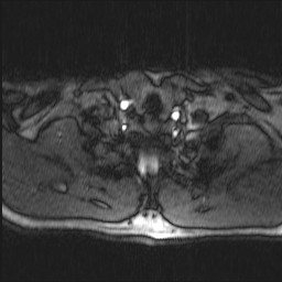 Carotid artery dissection (Radiopaedia 28441-28689 Axial MRA 10).jpg