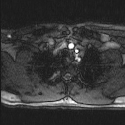 Carotid artery dissection (Radiopaedia 28441-28689 Axial MRA 2).jpg