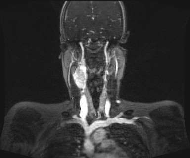 Carotid body tumor (Radiopaedia 12777-12912 MRA 32).jpg