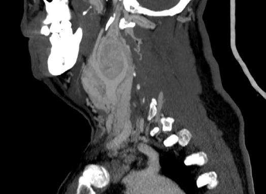 File:Carotid body tumor (Radiopaedia 17892-17654 D 1).jpg