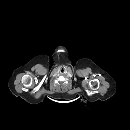 File:Carotid body tumor (Radiopaedia 21021-20948 B 18).jpg