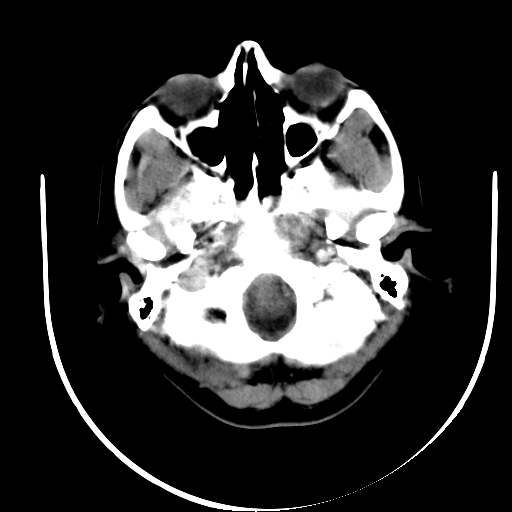 File:Carotid body tumor (Radiopaedia 27890-28124 A 3).jpg