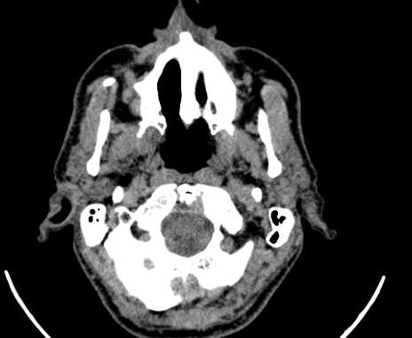 Carotid body tumor (Radiopaedia 61750-69757 Axial non-contrast 5).jpg