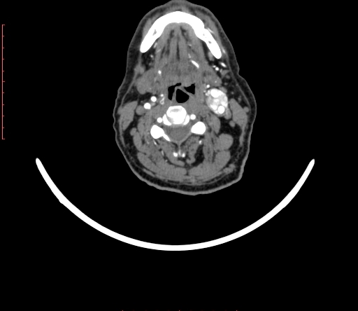 Carotid body tumor (Radiopaedia 66785-76116 B 41).jpg
