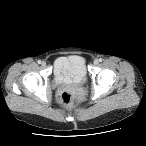 File:Castleman disease with fibrous pseudotumor in the abdomen (Radiopaedia 77296-89373 Axial 100).jpg