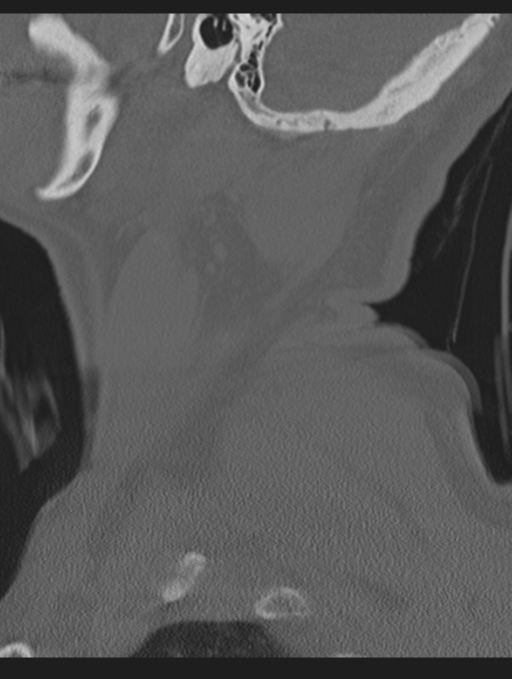 Cavernoma of cervical cord (Radiopaedia 50838-56346 Sagittal bone window 7).png