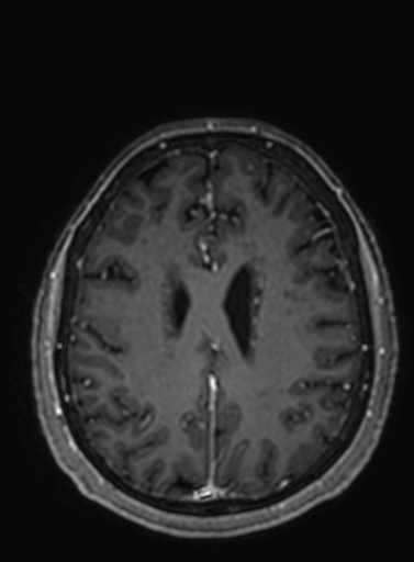 Cavernous hemangioma of the cerebellar falx (Radiopaedia 73025-83724 Axial T1 C+ 110).jpg