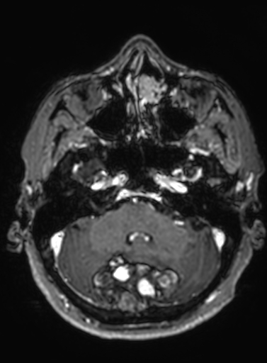 Cavernous hemangioma of the cerebellar falx (Radiopaedia 73025-83724 Axial T1 C+ 257).jpg