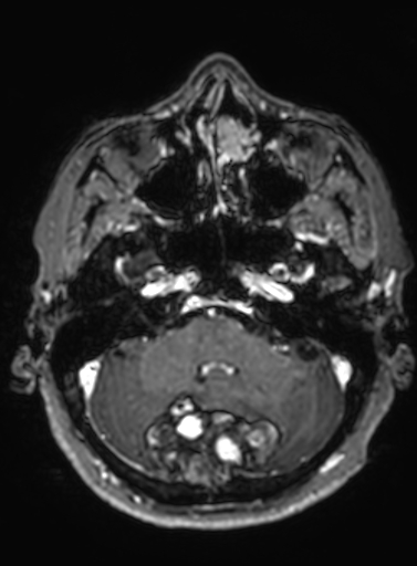 Cavernous hemangioma of the cerebellar falx (Radiopaedia 73025-83724 Axial T1 C+ 258).jpg